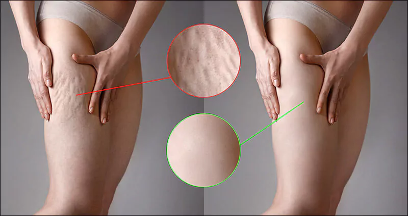 Cellulite Reduction Plan