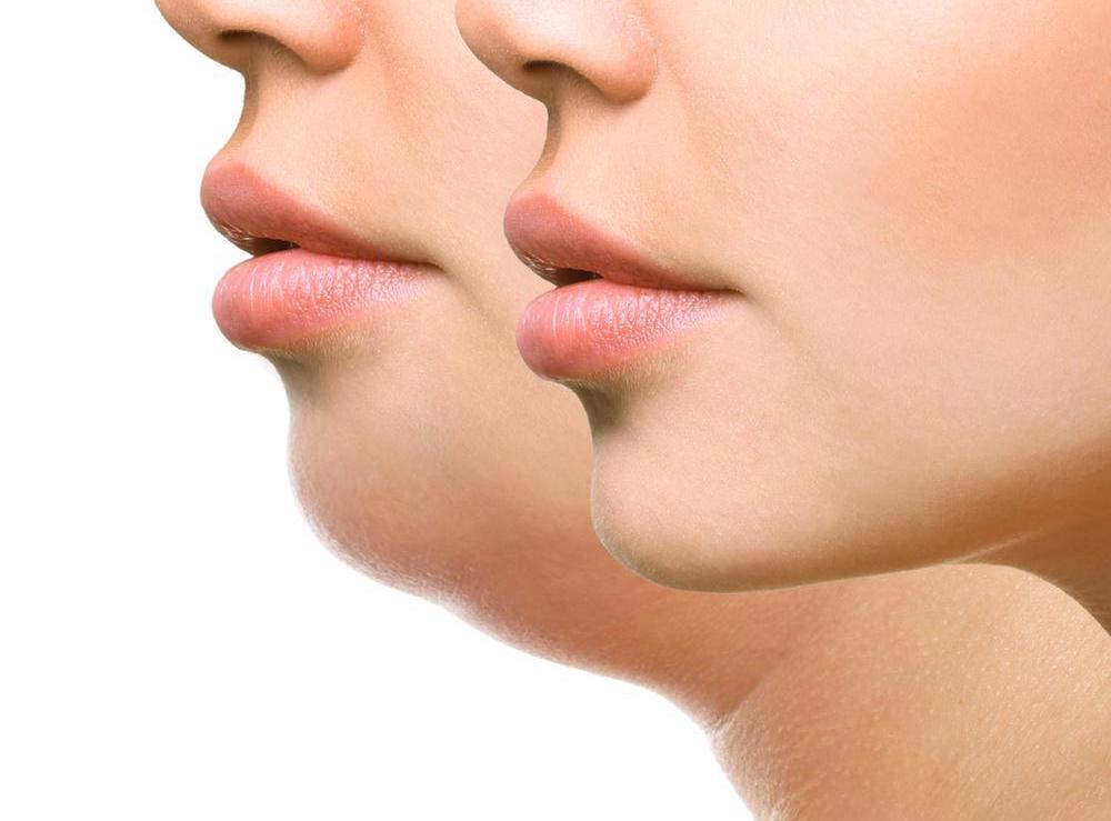 Jawline & Neck Sculpting